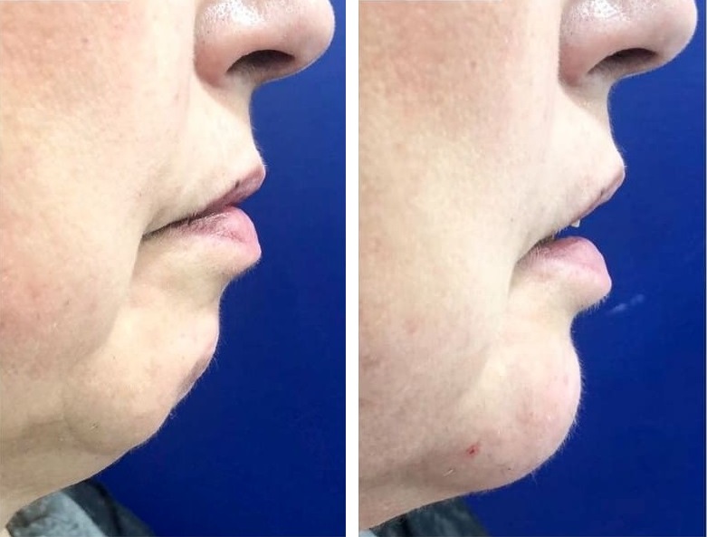Mentoplastia caso 2 — antes y después